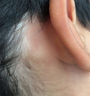 耳の後ろから首にかけてのシコリ 原因は帯状疱疹でした お専務通信